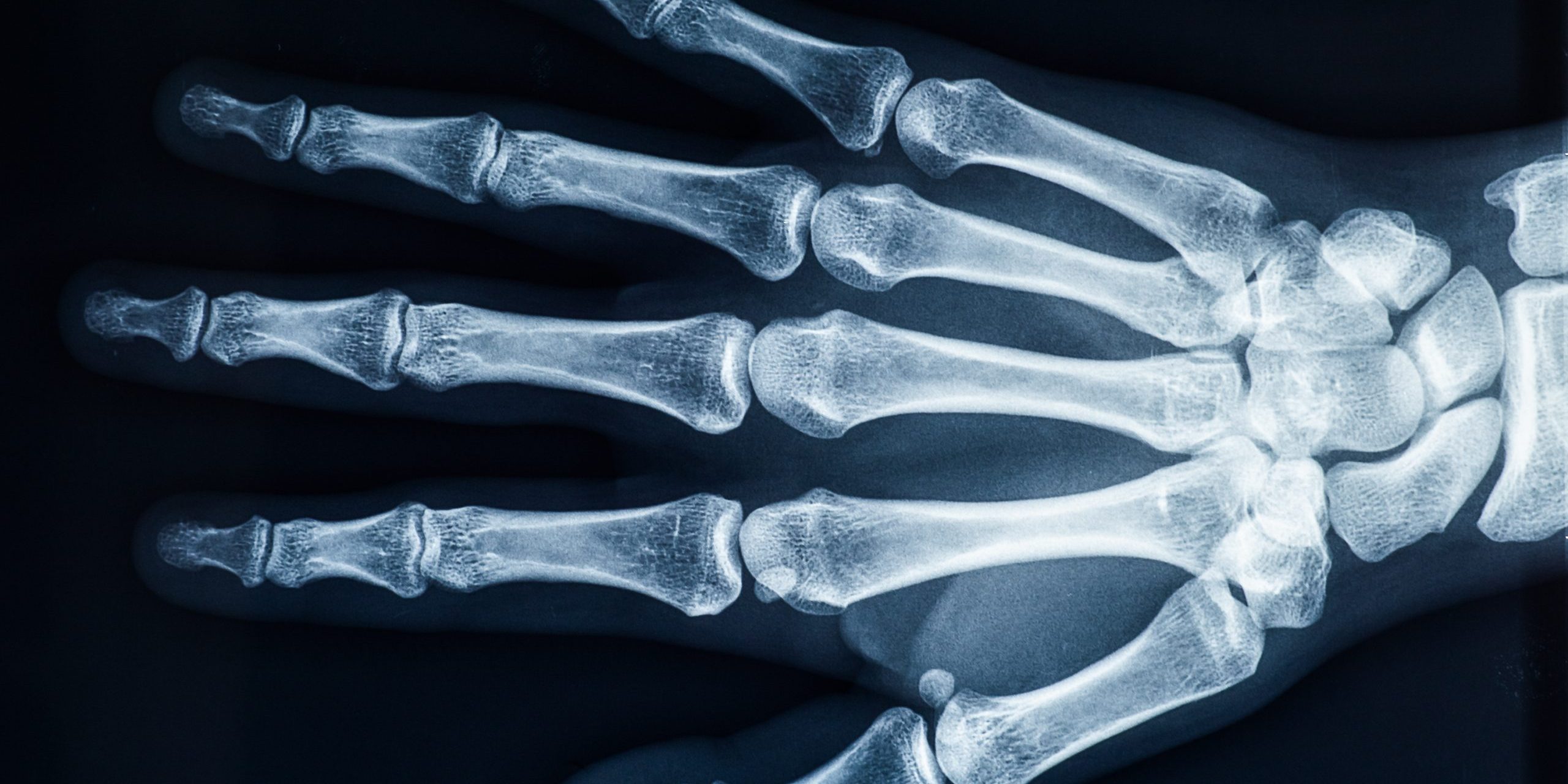 Human adult female right hand bones x-ray image. Medical and anatomy radiography or imagery.